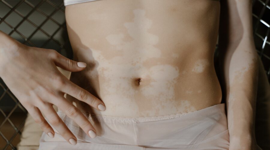 Le Vitiligo, maladie de l'épiderme : causes et traitements