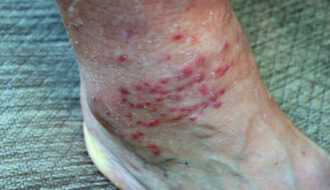 Piqûres d'aoûtats : comment les reconnaître et les soulager ?